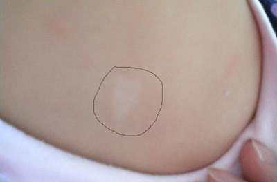白霜胎记小意思斑点女儿(白霜胎记斑点小意思女儿)