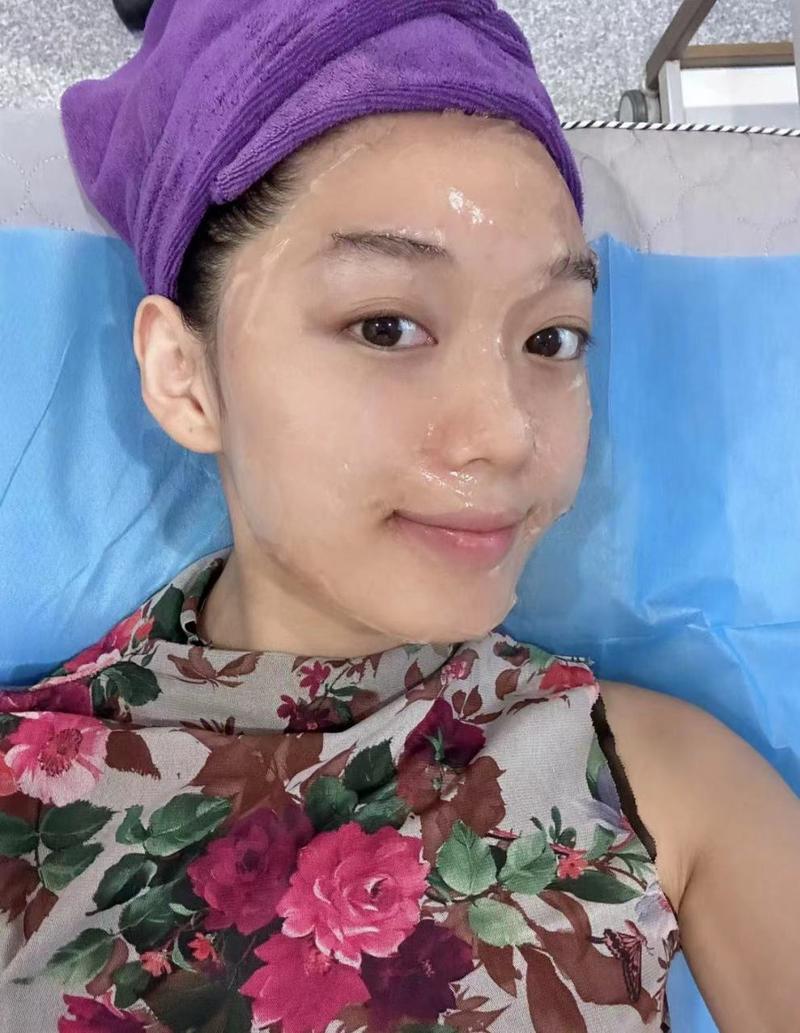 嫩肤光子美白入门级祛痘AOPT(光子嫩肤医生皮肤美白)
