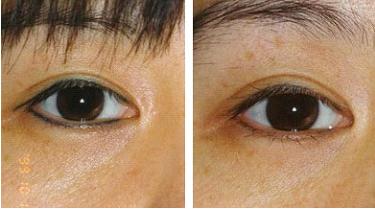 郑州眼线天后洗掉激光烦恼(眼线整形医院激光郑州东北网)
