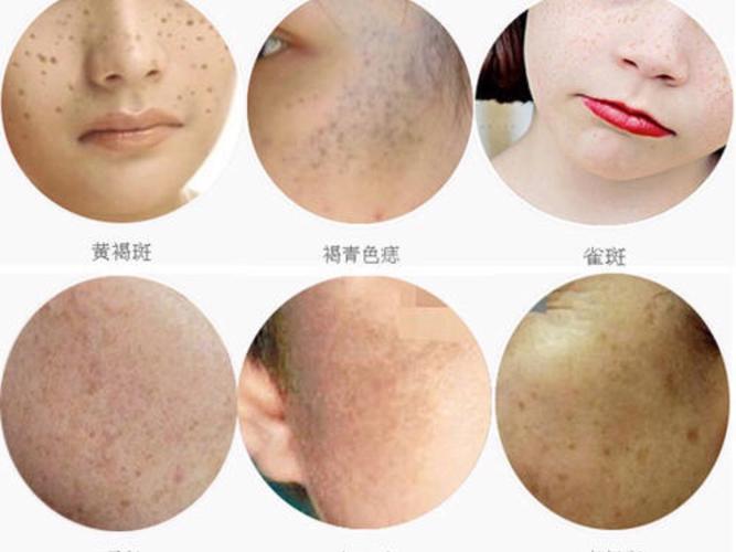 帮你教你色斑很难看脸上(色斑家庭医生在线肌肤灯笼)