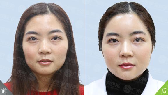 五年换来脸部怪异容颜石家(女士医院手术医生吸脂)