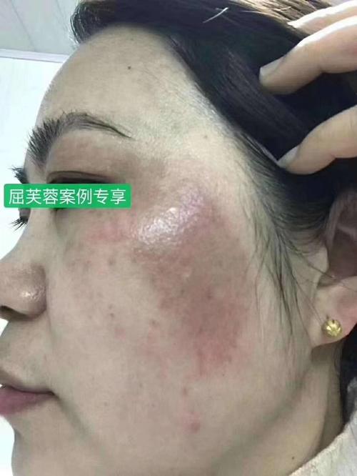 刀疤还敢关公工作室溶斑溶成(皮肤面部疤痕刀疤女士)