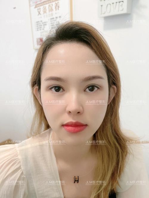 就能双眼皮日本几分钟不开刀(双眼皮日本就能几分钟不开刀)