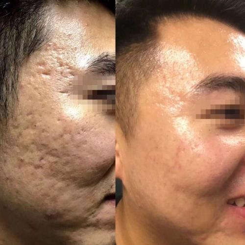 粗大毛孔痘坑(毛孔粗大点阵射频激光)