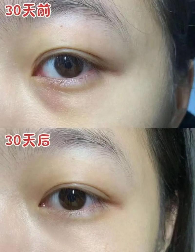 黑眼圈在这里了快速方法(黑眼圈猪肝生姜眼袋红糖)