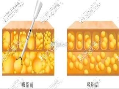 抽脂(抽脂手术脂肪细胞体重)
