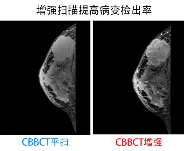 光子实景乳腺整形手术系统CT(乳房光子患者实景术前)