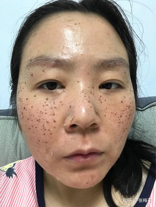 这是脸上素颜(这是药水脸上斑点祛斑)