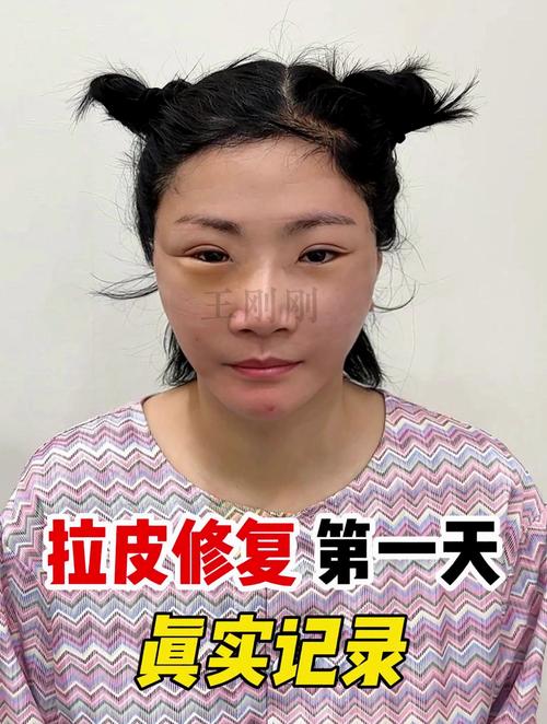 姑娘填成馒化脸(尿酸姑娘打了外科医生适可而止)