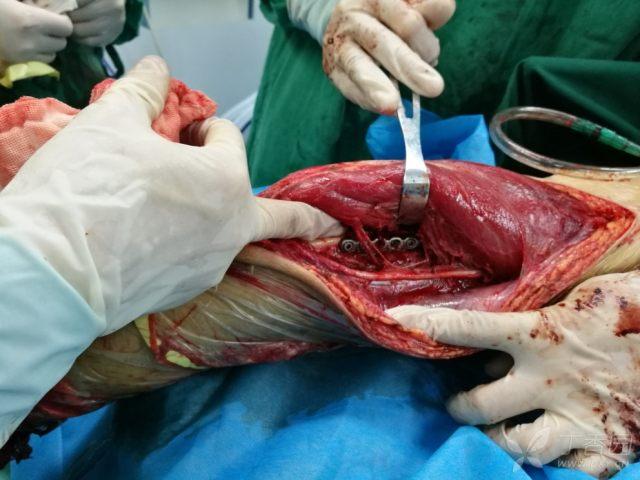 肱骨上海远端表面手术假体(肘关节骨科肱骨文汇假体)