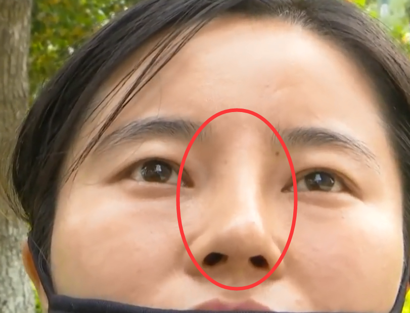万元隆鼻昆明歪了她太没良心(隆鼻万元昆明鼻子女士)