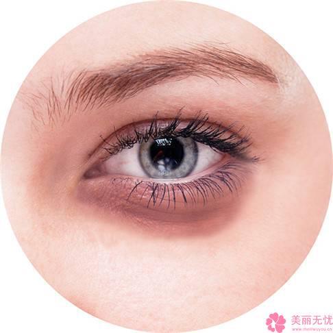 黑眼圈激光自爆(激光黑眼圈在线自爆家庭医生)