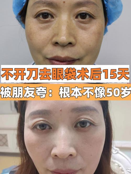 只为深圳大姐外地效果不开刀(只为深圳大姐去眼袋眼袋)