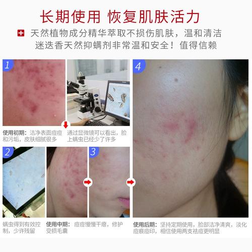 皮肤科好用祛痘脸上螨虫专家(螨虫皮肤硫磺脸上方法)