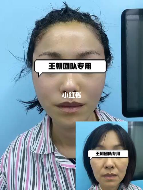 拉皮术后堪比换脸姐姐苹果(拉皮术后苹果这是堪比)