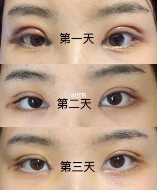 双眼皮来看看能做能不手术眼睛(双眼皮眼睛手术能做能不)
