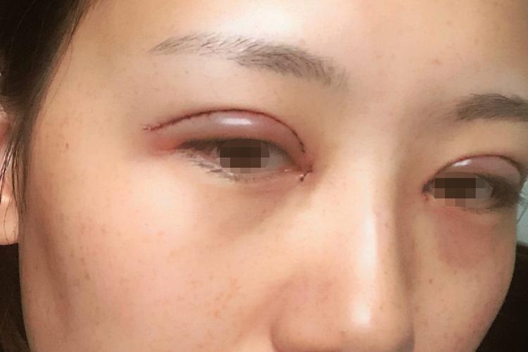 这份最全仔细手术攻略割双眼皮(双眼皮手术术后湖南眼睑)