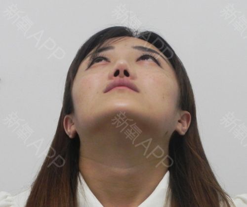 鼻孔隆鼻对称女子(女士澎湃鼻孔手术隆鼻)