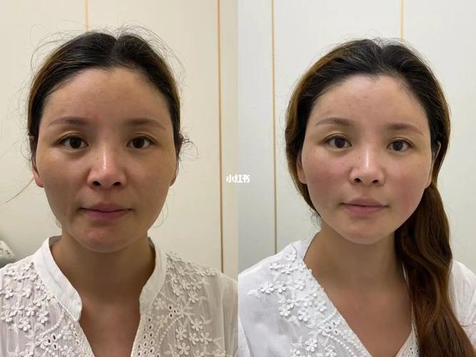 面部抗衰老(面部松弛美容整形医疗抗衰老)