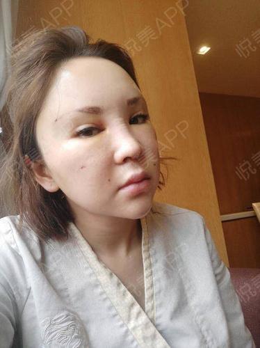 隆鼻软骨术后女子发现(软骨女士术后隆鼻手术)