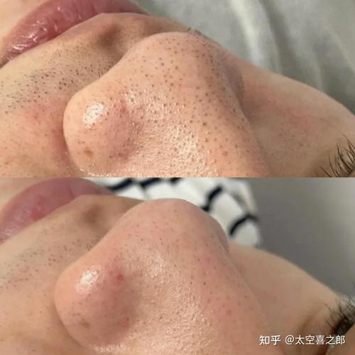 武汉仙女去黑头(黑头涂上我是去黑头做完)