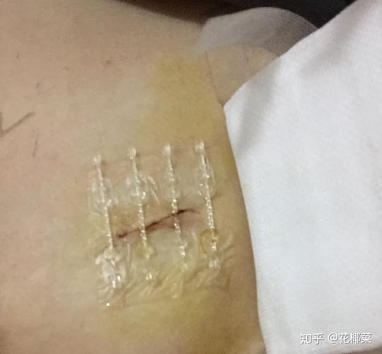 瘢痕乳房直线(乳房乳头瘢痕乳腺手术)
