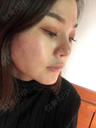 隆鼻下巴经验SuJi(下巴隆鼻经验术后鼻子)