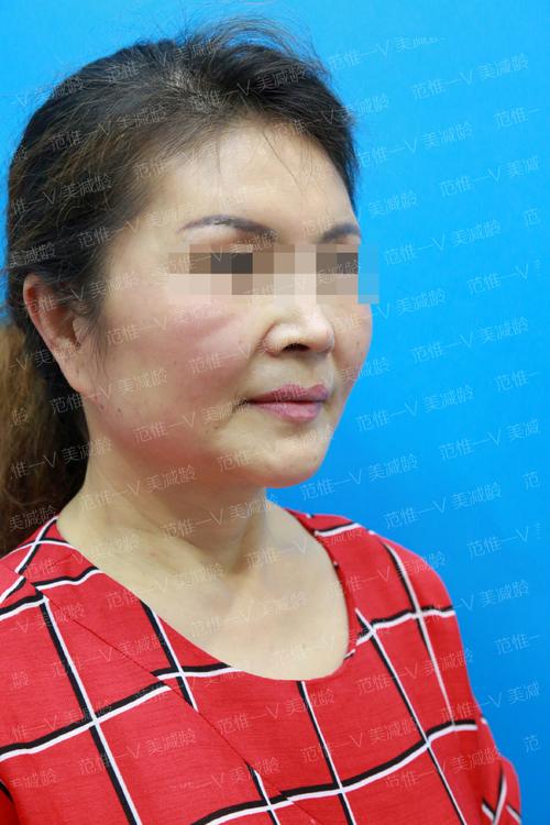 的人性价比医生项目抗衰医美(的人松弛医生拉皮面部)