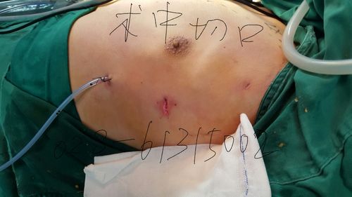 微创烦恼大胸少年腔镜术(乳腺手术乳房阿华男性)