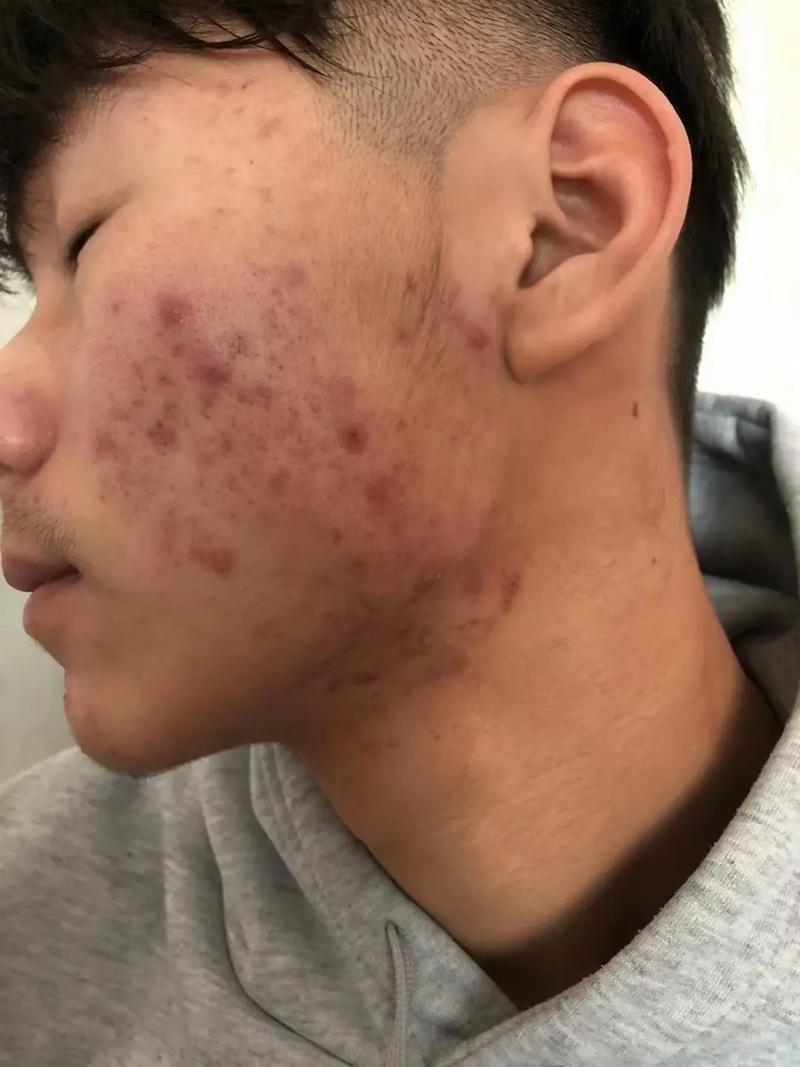 (痘痘黑头皮肤可能会黑斑)