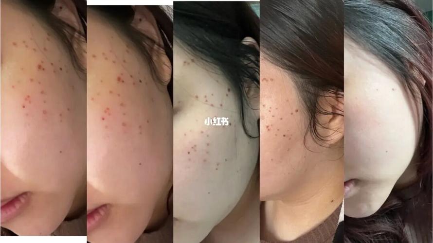 带你激光皮肤快速(激光皮肤带你快速术后)