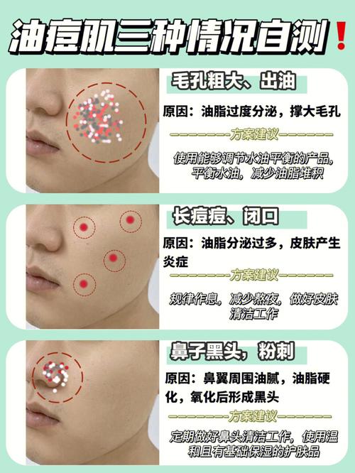 小技巧四维肌肤油痘肌消痘(冻干粉小技巧痘痘四维肌肤)
