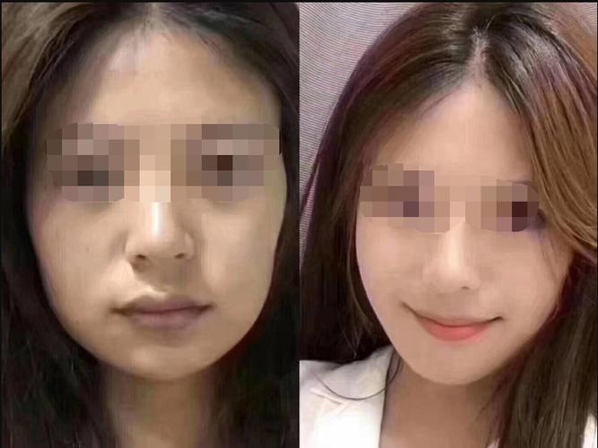面部脂肪新趋势(脂肪面部效果患者术后)