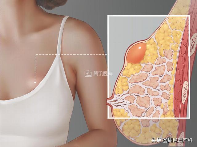 这件事乳房(乳房乳腺女性这件事乳腺癌)