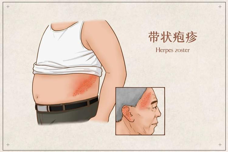 涟源疱疹省级疗法结束项目(疱疹疗法带状疱疹患者神经痛)