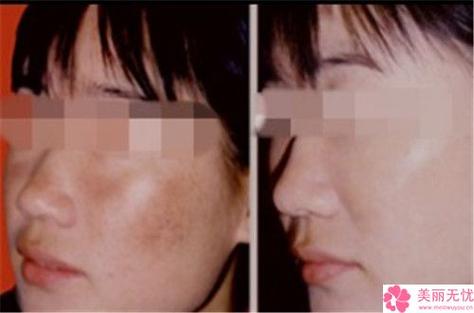 还在红宝石色斑激光患者小仙女(激光红宝石色斑还在黄褐斑)