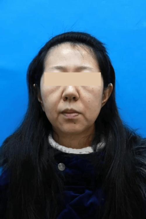 拉皮说她面部吸脂少女轮廓线(拉皮面部说她吸脂手术)