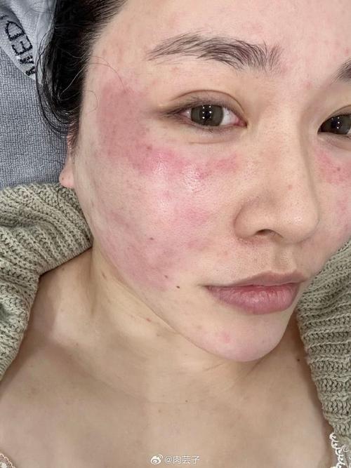 大军光电美肤脱敏(敏感皮肤肌肤光电防晒)