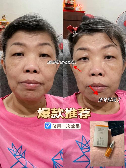 那么多法令困扰提拉脸上方法(法令尿酸那么多医生方法)