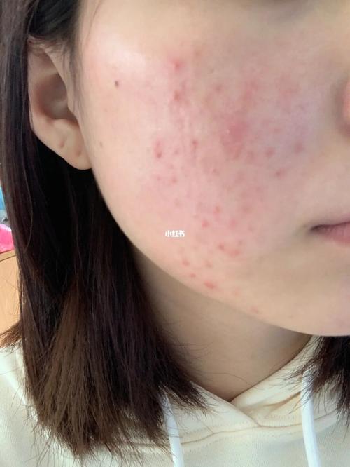 是因为没了痘痘疗法抗衰老找到了(高压氧疗法是因为没了痘痘)