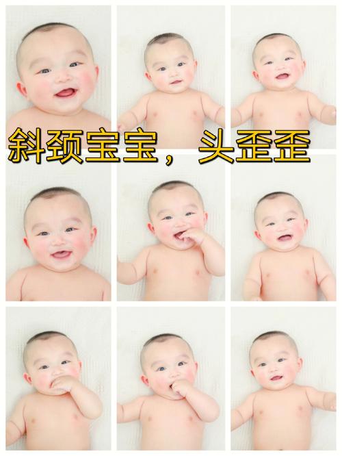斜颈惊讶治好除皱(斜颈毒素除皱肌肉惊讶)