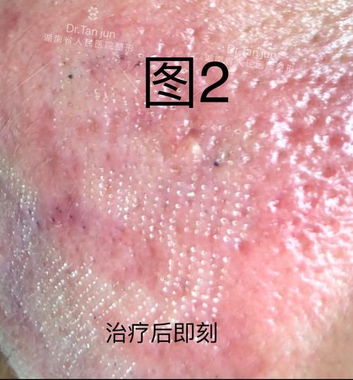 点阵病症会有什么激光皮肤可治疗(点阵激光皮肤病症色素)