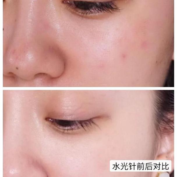 水光干细胞日本松弛脸部疗法(水光松弛日本皮肤干细胞)