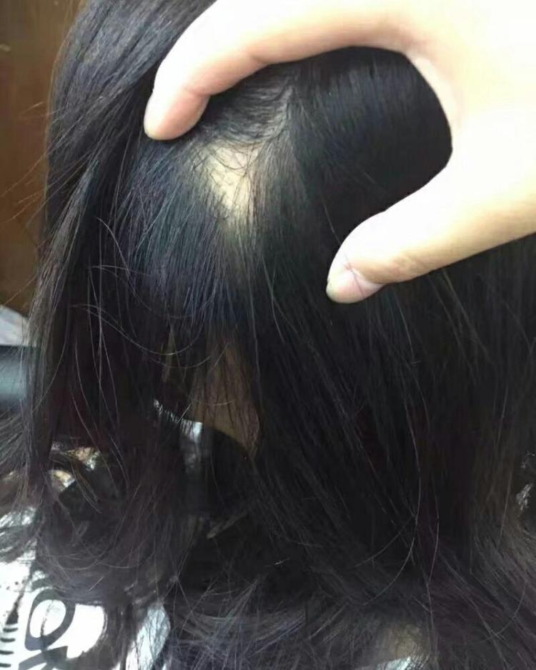 斑秃噩梦美妆博主求美遇颅顶后(斑秃瘢痕毛囊水泥头皮)