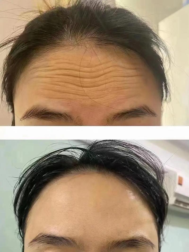 除皱(除皱都是美容院脸上皱纹)