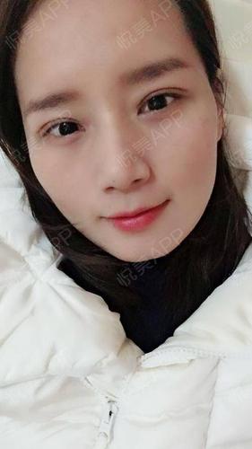 惊艳春节快速项目(术后春节手术双眼皮惊艳)
