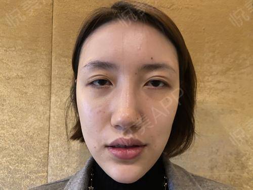 之窗眼部心灵(双眼皮眼部手术之窗眼角)