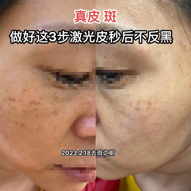 激光不遗斑(激光青白江区皮肤黑色素祛斑)