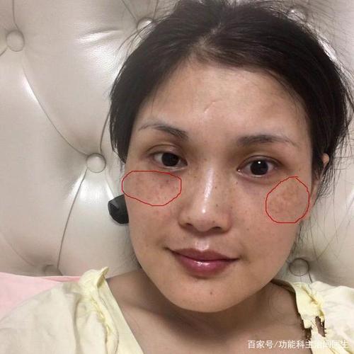 是有黄褐斑就好了招清走(自己的黄褐斑皮肤是有果酸)