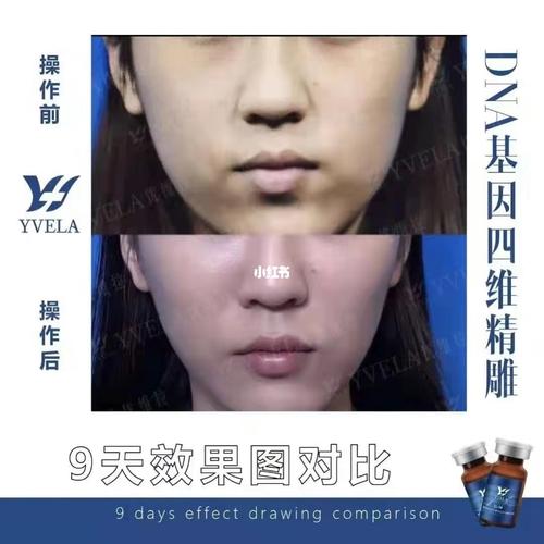 助力轮廓四维精雕火爆医疗(轮廓四维精雕医疗女性)